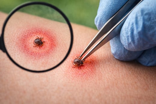 вадене на кърлеж